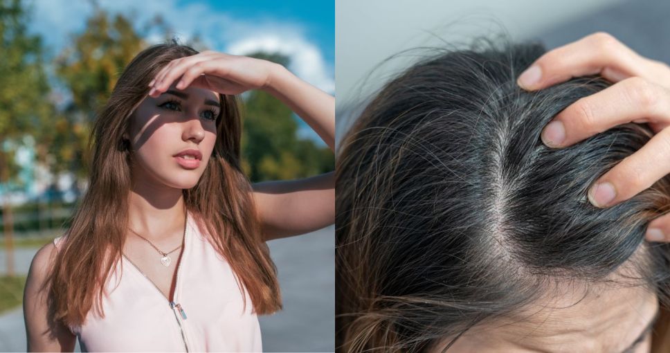 頭皮曬傷｜夏天曬傷頭皮怎麼辦？髮理專家分享頭皮曬傷護理+預防方法【專欄】